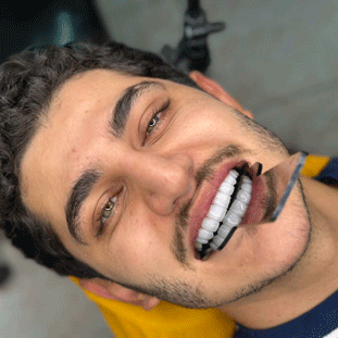 کامپوزیت لبه شیشه ای